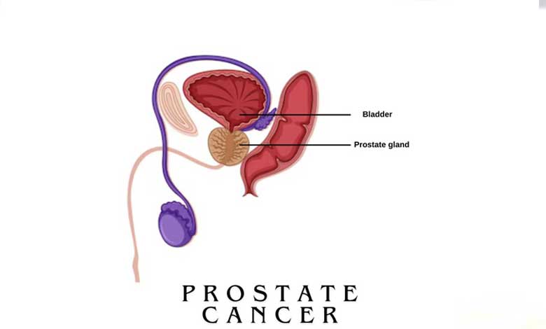 Prostate cancer cases rising among men aged below 50 in India: Experts – The Munsif Daily